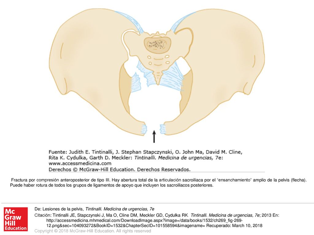 Fractura por compresión anteroposterior de tipo III