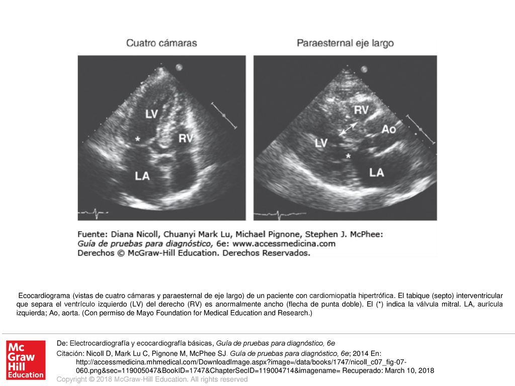 Ecocardiograma (vistas de cuatro cámaras y paraesternal de eje largo) de un paciente con cardiomiopatía hipertrófica. El tabique (septo) interventricular que separa el ventrículo izquierdo (LV) del derecho (RV) es anormalmente ancho (flecha de punta doble). El (*) indica la válvula mitral. LA, aurícula izquierda; Ao, aorta. (Con permiso de Mayo Foundation for Medical Education and Research.)