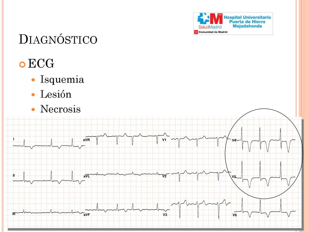 Diagnóstico ECG Isquemia Lesión Necrosis I II III aVR aVL aVF V1 V2 V3