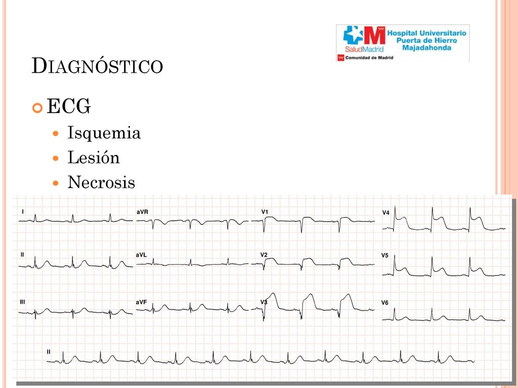 Diagnóstico ECG Isquemia Lesión Necrosis I II III aVR aVL aVF V1 V2 V3