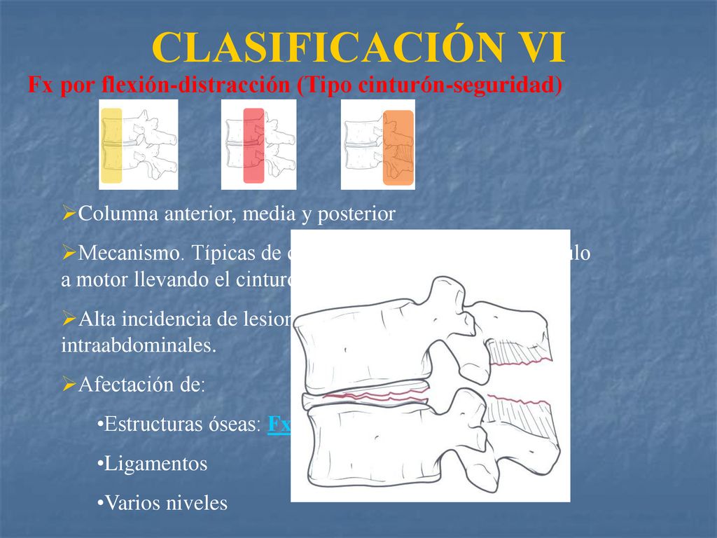 CLASIFICACIÓN VI Fx por flexión-distracción (Tipo cinturón-seguridad)