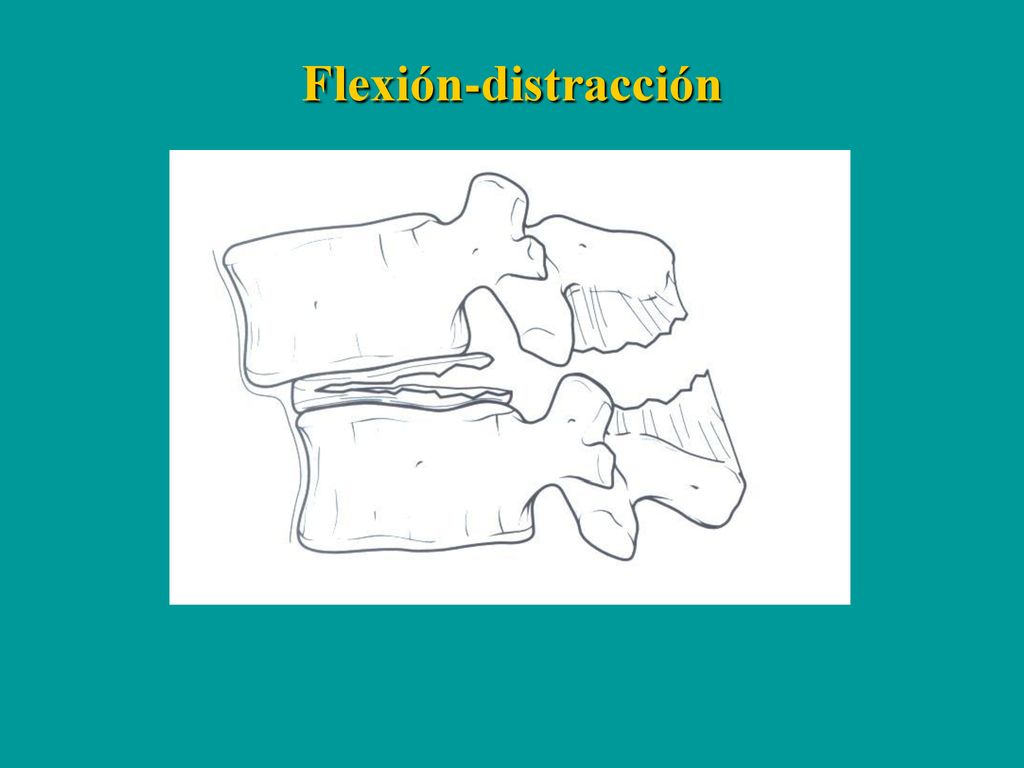 Flexión-distracción En flexión-distracción: fallo de las 3 columnas a tensión; a diferencia de la de Chance, aquí hay traslación significativa.