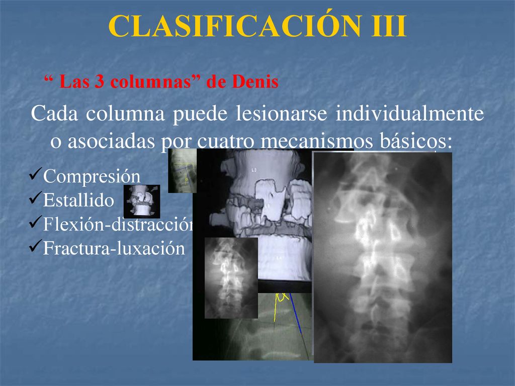 CLASIFICACIÓN III Las 3 columnas de Denis. Cada columna puede lesionarse individualmente o asociadas por cuatro mecanismos básicos: