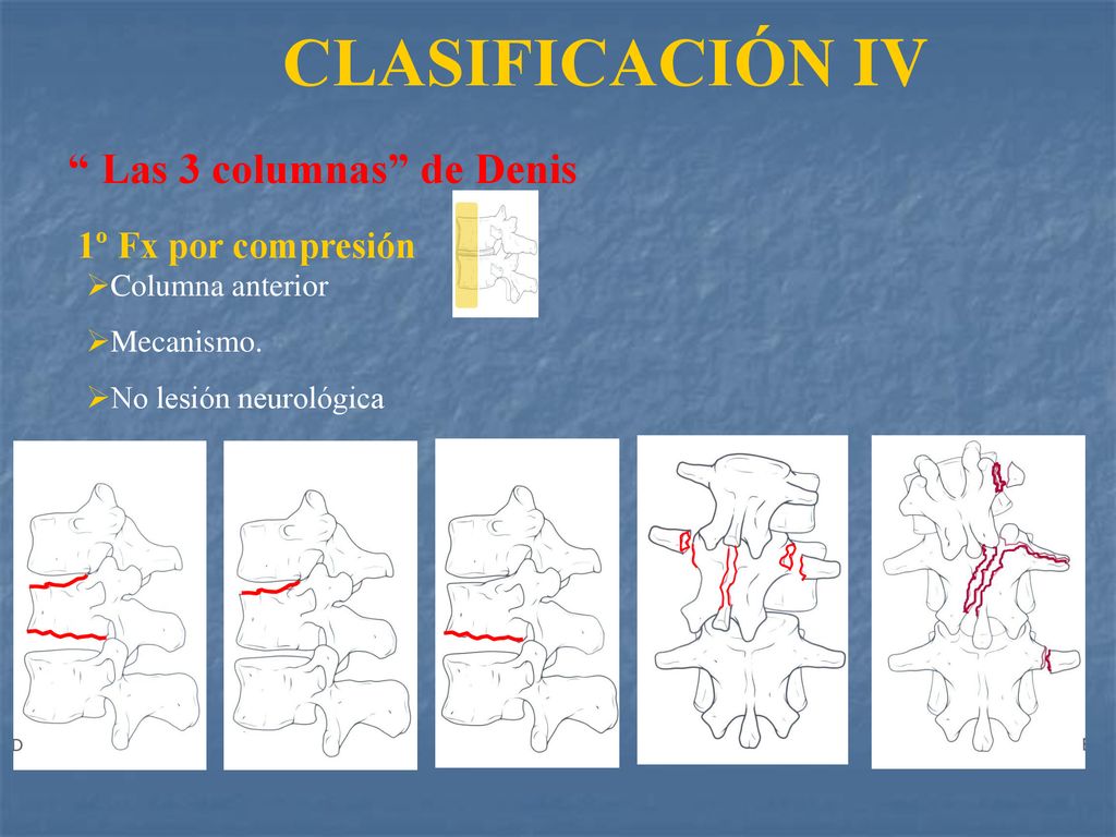 CLASIFICACIÓN IV Las 3 columnas de Denis 1º Fx por compresión