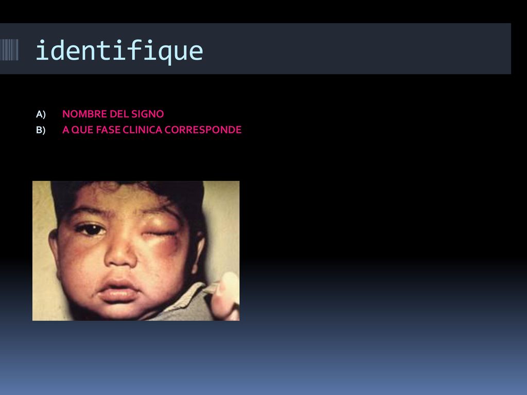 identifique NOMBRE DEL SIGNO A QUE FASE CLINICA CORRESPONDE