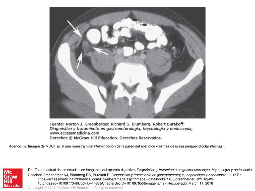 Apendicitis. Imagen de MDCT axial que muestra hiperintensificación de la pared del apéndice y estrías de grasa periapendicular (flechas).