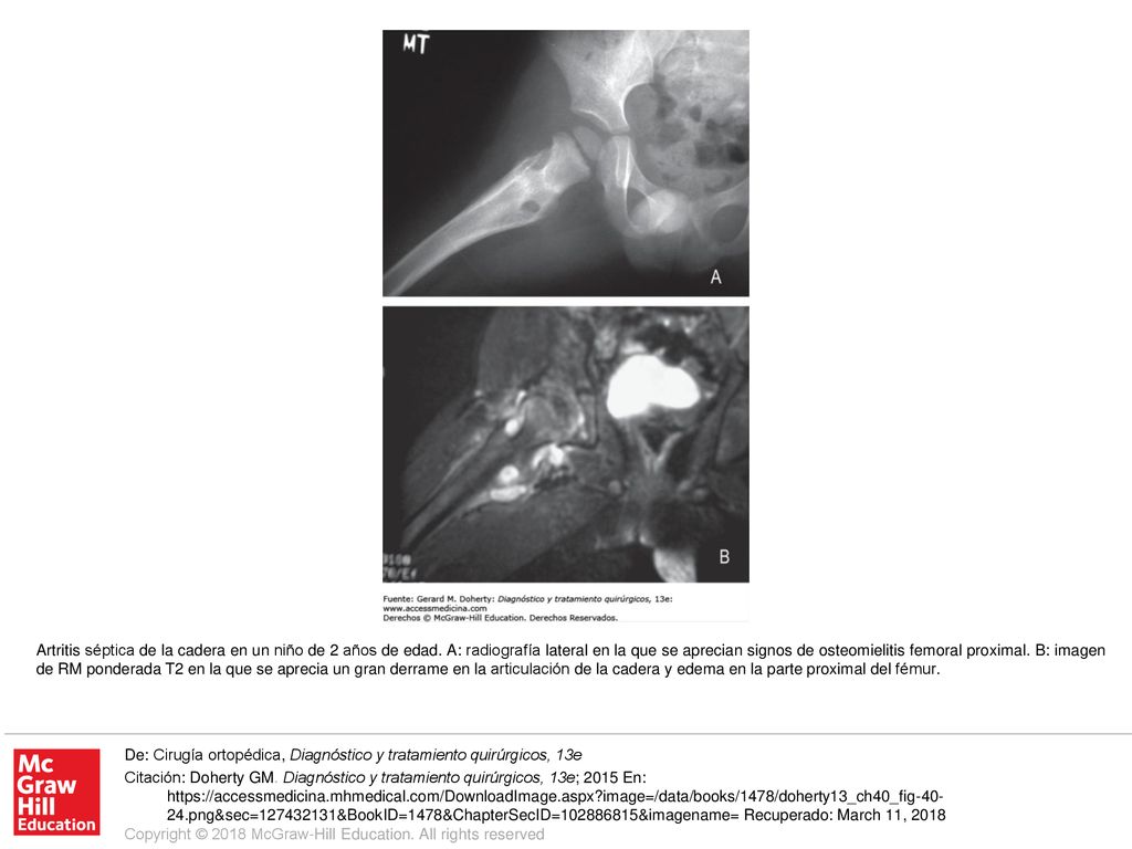 Artritis séptica de la cadera en un niño de 2 años de edad