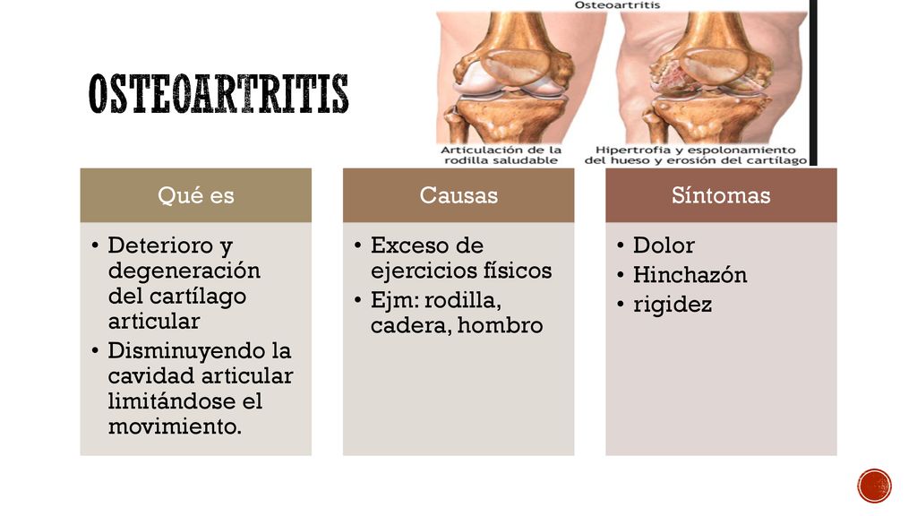 OSTEOARTRITIS Qué es Deterioro y degeneración del cartílago articular