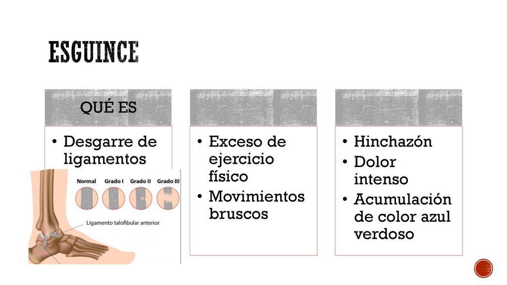 ESGUINCE QUÉ ES Desgarre de ligamentos Exceso de ejercicio físico