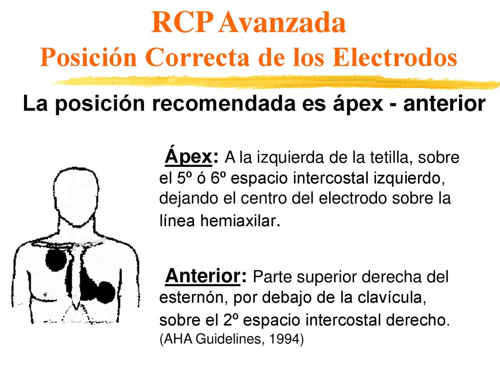 RCP Avanzada Posición Correcta de los Electrodos