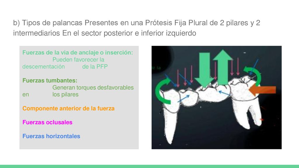 b) Tipos de palancas Presentes en una Prótesis Fija Plural de 2 pilares y 2 intermediarios En el sector posterior e inferior izquierdo