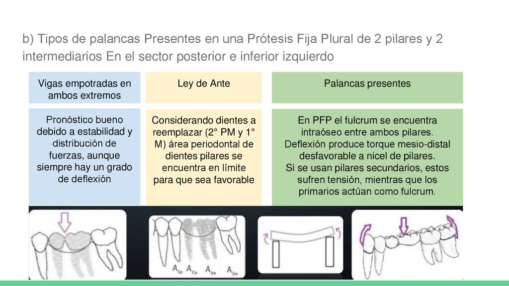 b) Tipos de palancas Presentes en una Prótesis Fija Plural de 2 pilares y 2 intermediarios En el sector posterior e inferior izquierdo