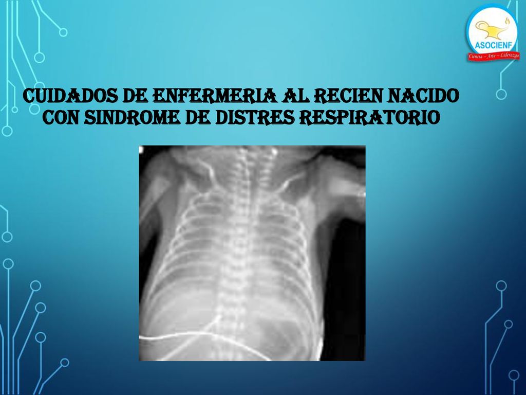 CUIDADOS DE ENFERMERIA AL RECIEN NACIDO con SINDROME DE DISTRES RESPIRATORIO