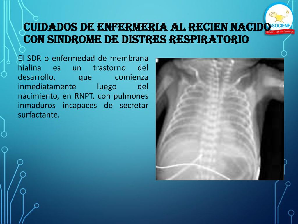 CUIDADOS DE ENFERMERIA AL RECIEN NACIDO con SINDROME DE DISTRES RESPIRATORIO