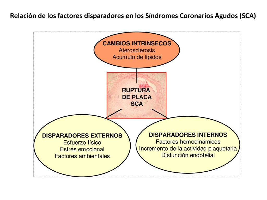 Relación de los factores disparadores en los Síndromes Coronarios Agudos (SCA)