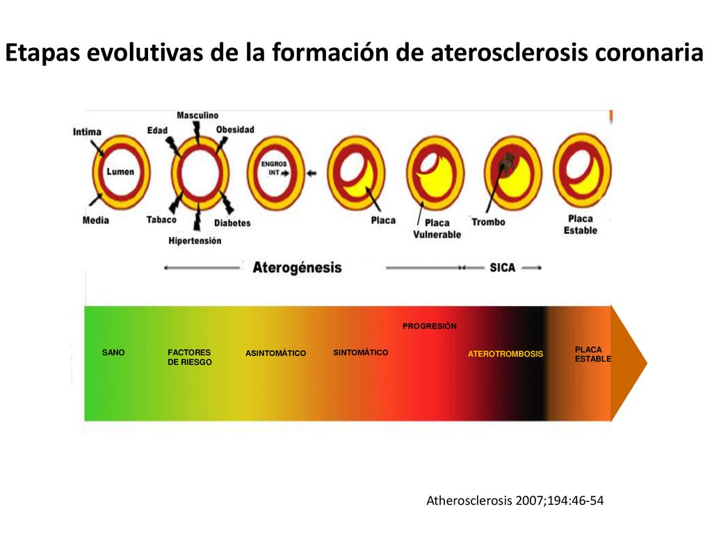 Etapas evolutivas de la formación de aterosclerosis coronaria