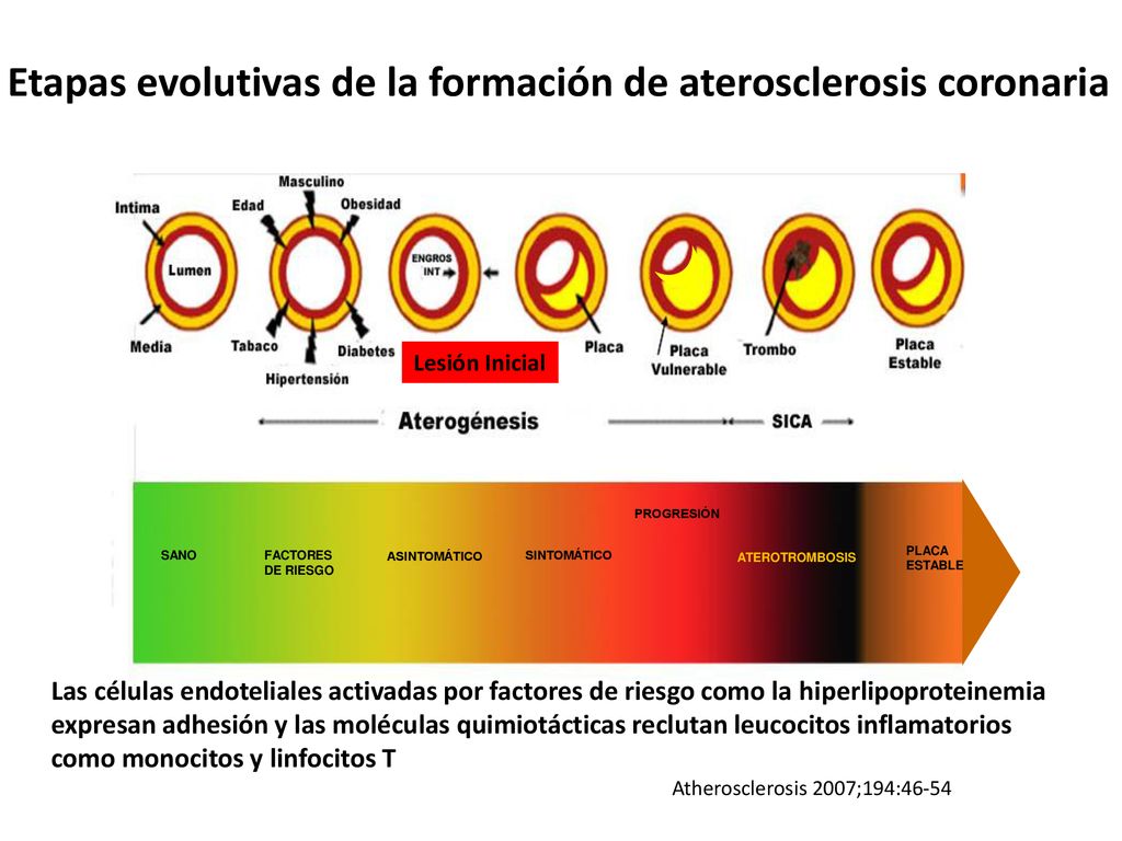 Etapas evolutivas de la formación de aterosclerosis coronaria