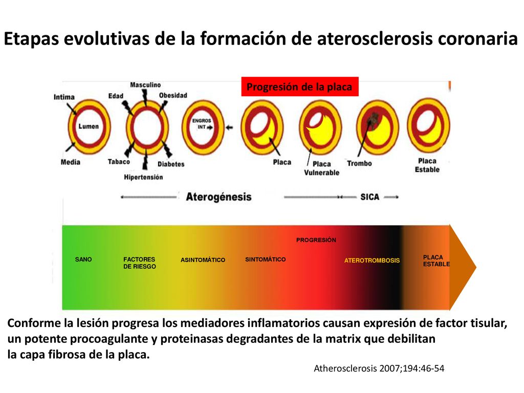 Etapas evolutivas de la formación de aterosclerosis coronaria