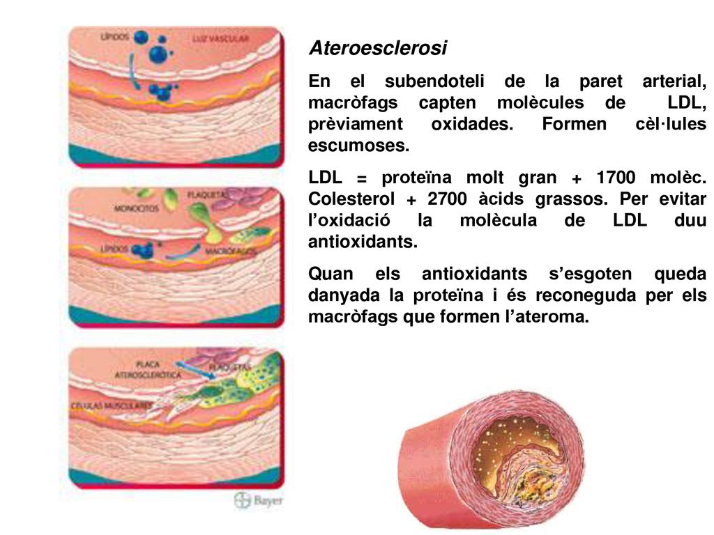 Ateroesclerosi En el subendoteli de la paret arterial, macròfags capten molècules de LDL, prèviament oxidades. Formen cèl·lules escumoses.