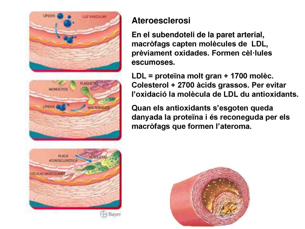 Ateroesclerosi En el subendoteli de la paret arterial, macròfags capten molècules de LDL, prèviament oxidades. Formen cèl·lules escumoses.