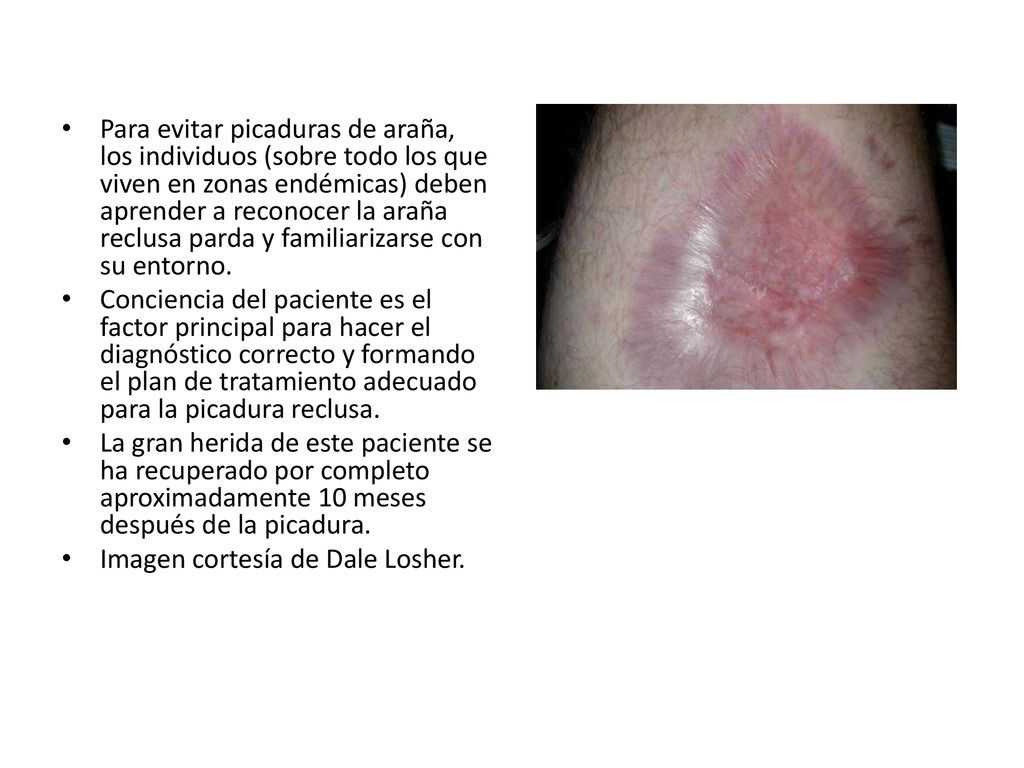 Mordedura Por Arana Laxocesles Reclusa Ppt Descargar