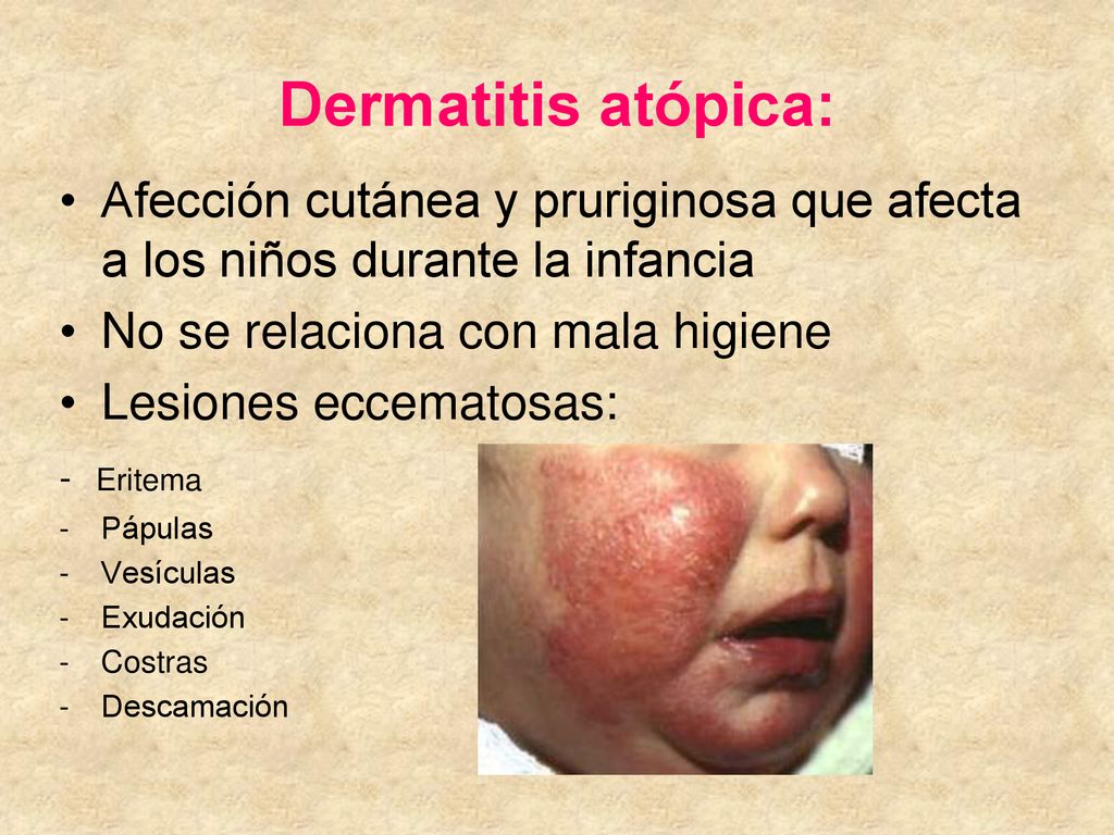 Dermatitis atópica: Afección cutánea y pruriginosa que afecta a los niños durante la infancia. No se relaciona con mala higiene.