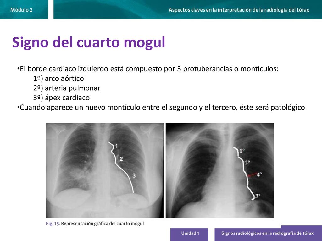 Signo del cuarto mogul El borde cardiaco izquierdo está compuesto por 3 protuberancias o montículos: