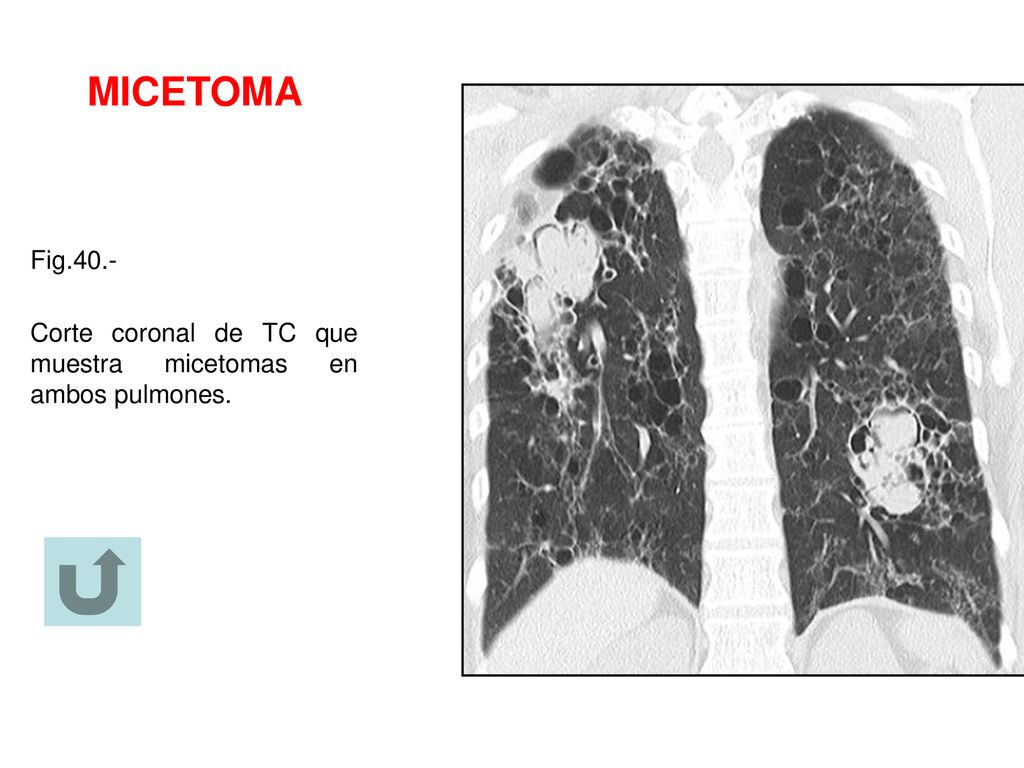 MICETOMA Fig.40.- Corte coronal de TC que muestra micetomas en ambos pulmones.