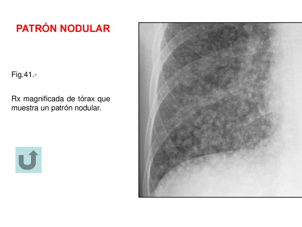 PATRÓN NODULAR Fig.41.- Rx magnificada de tórax que muestra un patrón nodular.