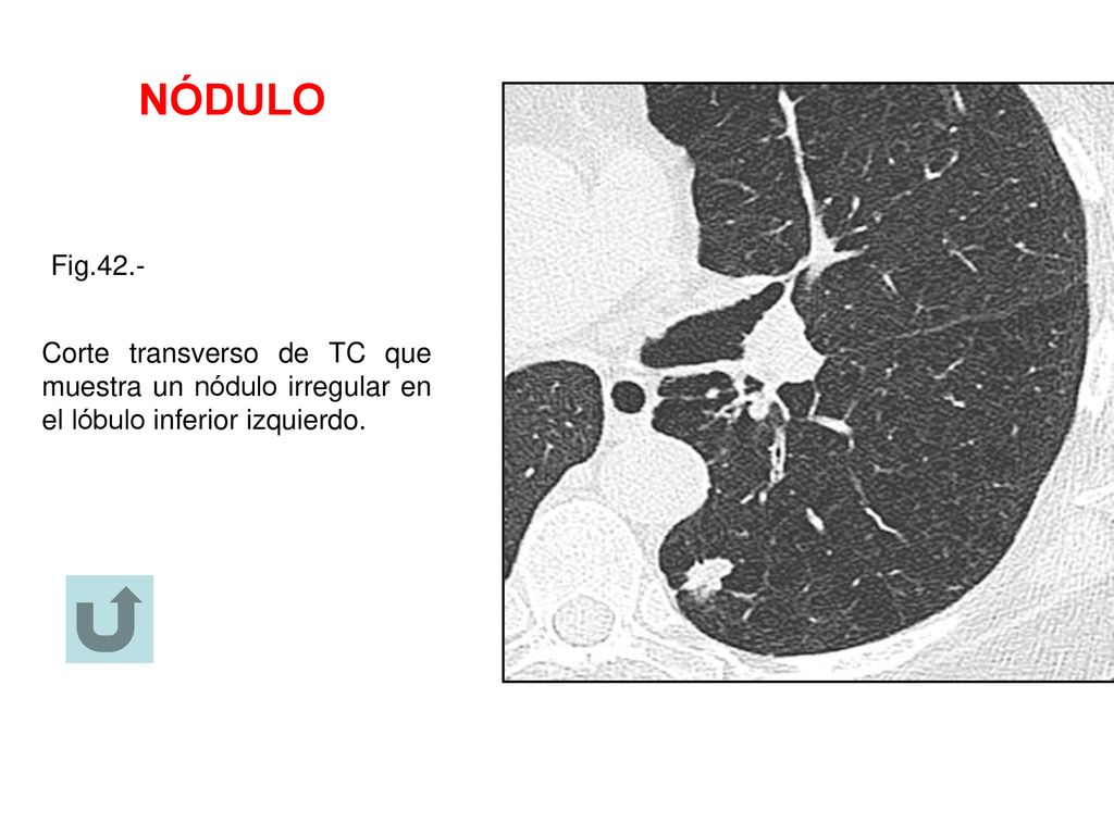 NÓDULO Fig.42.- Corte transverso de TC que muestra un nódulo irregular en el lóbulo inferior izquierdo.