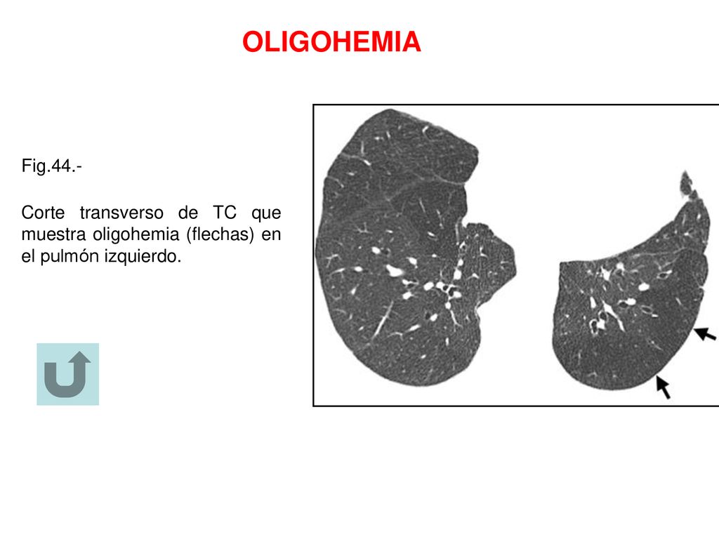OLIGOHEMIA Fig.44.- Corte transverso de TC que muestra oligohemia (flechas) en el pulmón izquierdo.