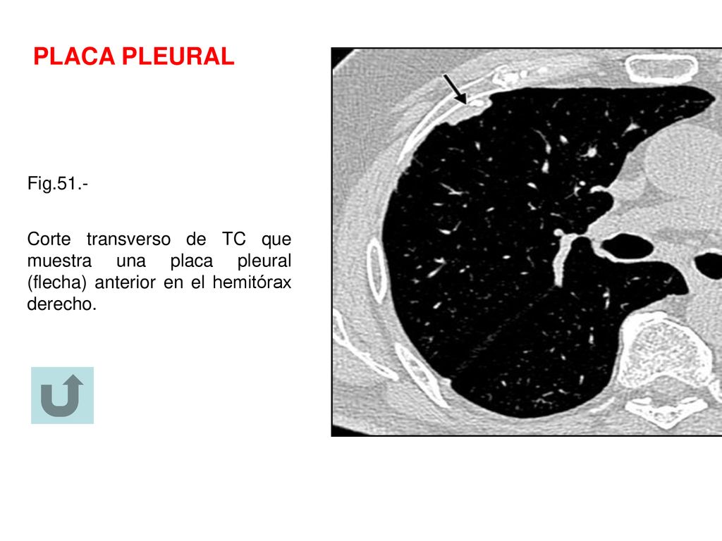 PLACA PLEURAL Fig.51.- Corte transverso de TC que muestra una placa pleural (flecha) anterior en el hemitórax derecho.