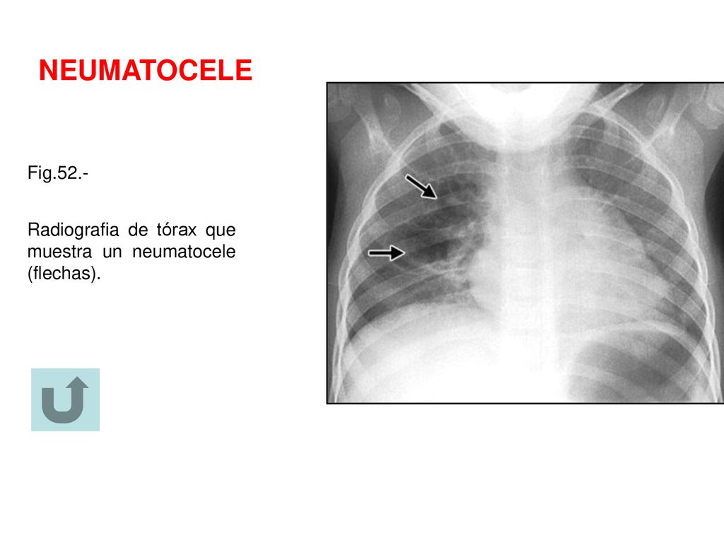 NEUMATOCELE Fig.52.- Radiografia de tórax que muestra un neumatocele (flechas).