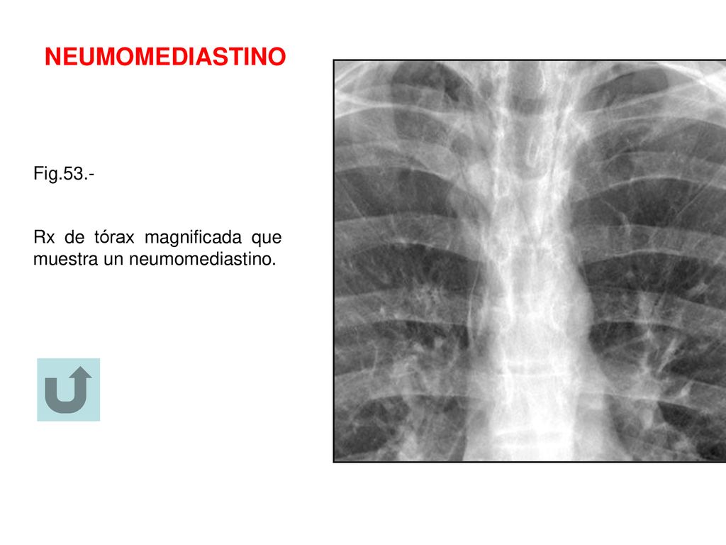 NEUMOMEDIASTINO Fig.53.- Rx de tórax magnificada que muestra un neumomediastino.