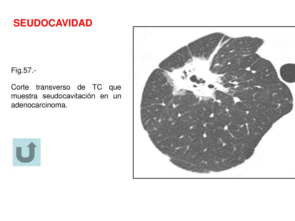 SEUDOCAVIDAD Fig.57.- Corte transverso de TC que muestra seudocavitación en un adenocarcinoma.