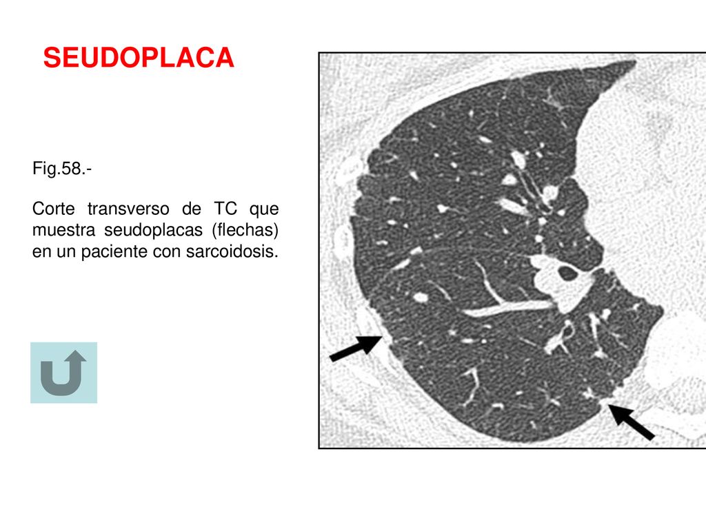 SEUDOPLACA Fig.58.- Corte transverso de TC que muestra seudoplacas (flechas) en un paciente con sarcoidosis.