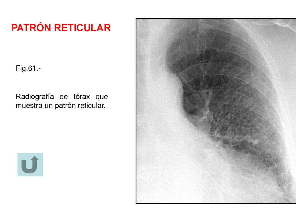 PATRÓN RETICULAR Fig.61.- Radiografía de tórax que muestra un patrón reticular.