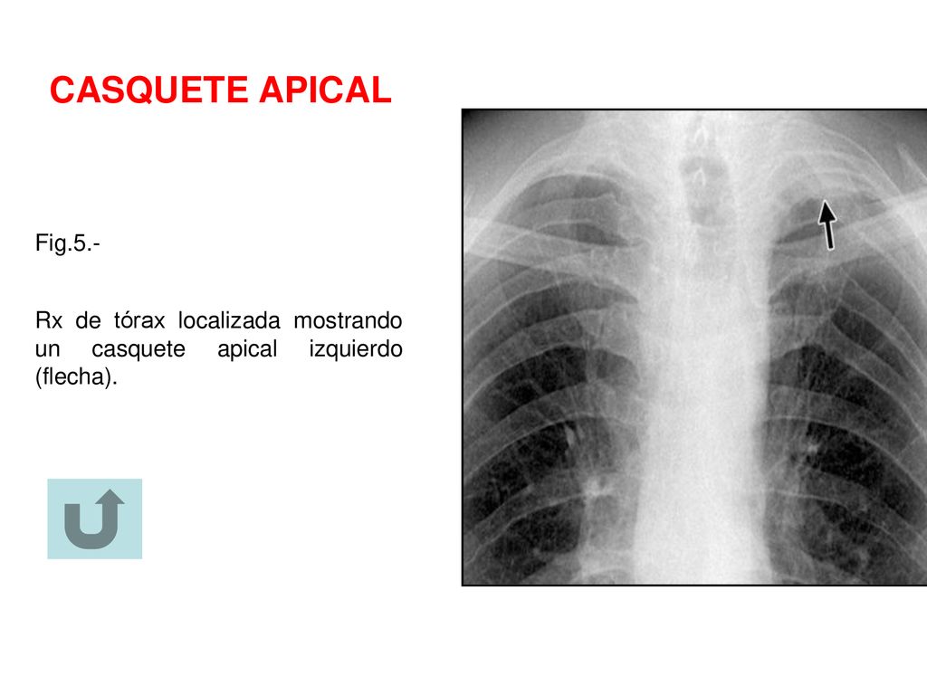 CASQUETE APICAL Fig.5.- Rx de tórax localizada mostrando un casquete apical izquierdo (flecha).