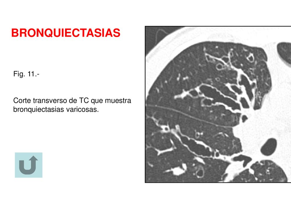 BRONQUIECTASIAS Fig Corte transverso de TC que muestra bronquiectasias varicosas.