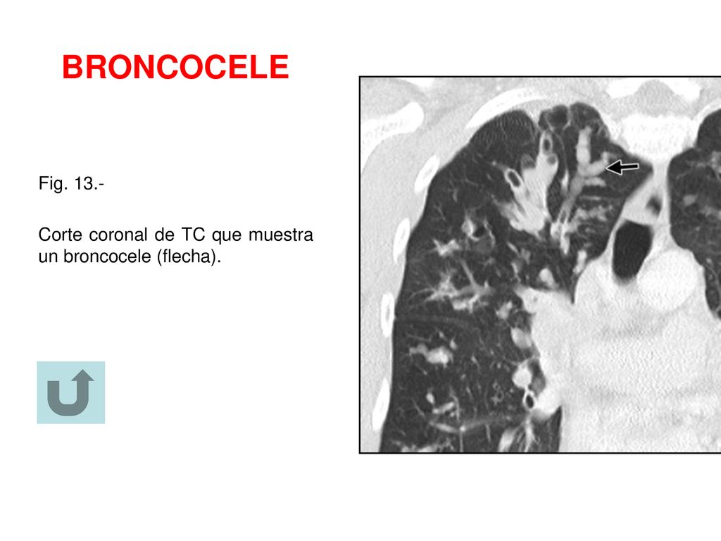 BRONCOCELE Fig Corte coronal de TC que muestra un broncocele (flecha).