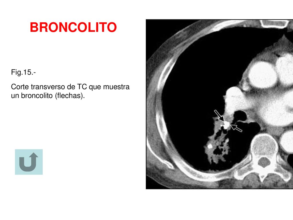 BRONCOLITO Fig.15.- Corte transverso de TC que muestra un broncolito (flechas).
