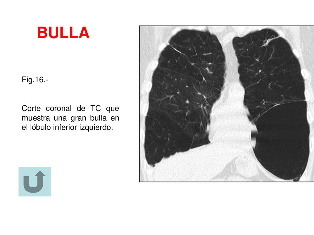 BULLA Fig.16.- Corte coronal de TC que muestra una gran bulla en el lóbulo inferior izquierdo.