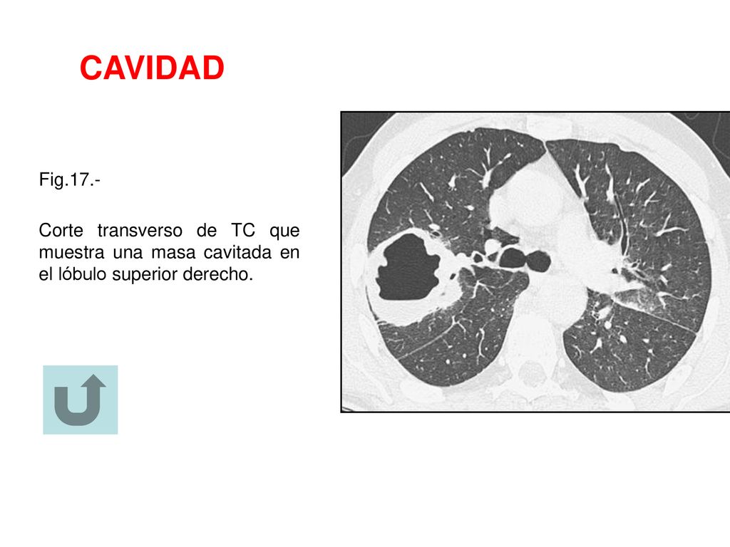 CAVIDAD Fig.17.- Corte transverso de TC que muestra una masa cavitada en el lóbulo superior derecho.