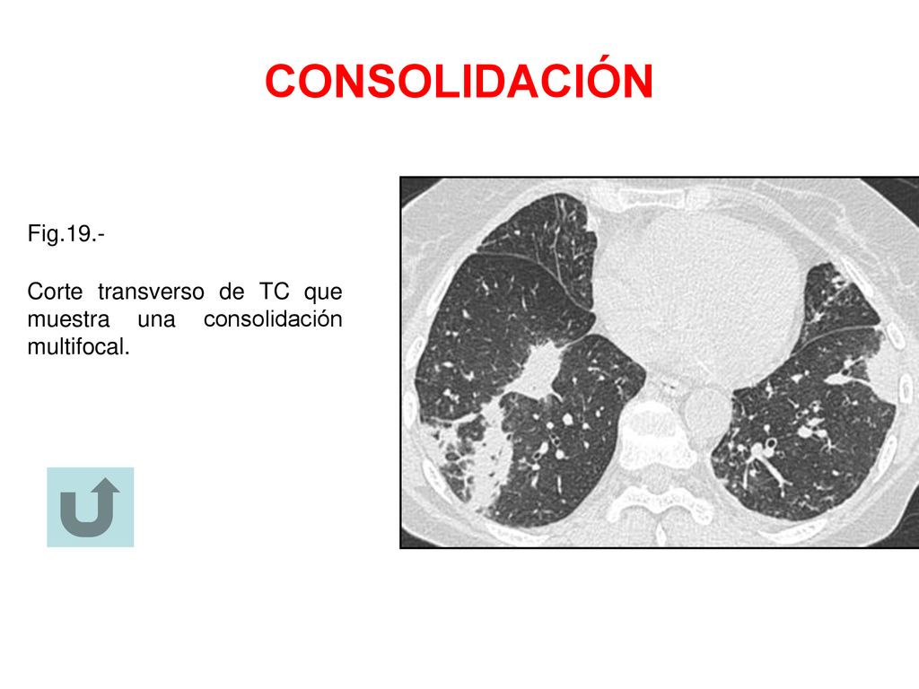 CONSOLIDACIÓN Fig.19.- Corte transverso de TC que muestra una consolidación multifocal.