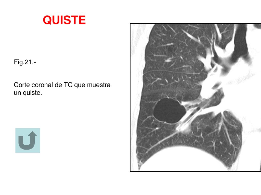 QUISTE Fig.21.- Corte coronal de TC que muestra un quiste.