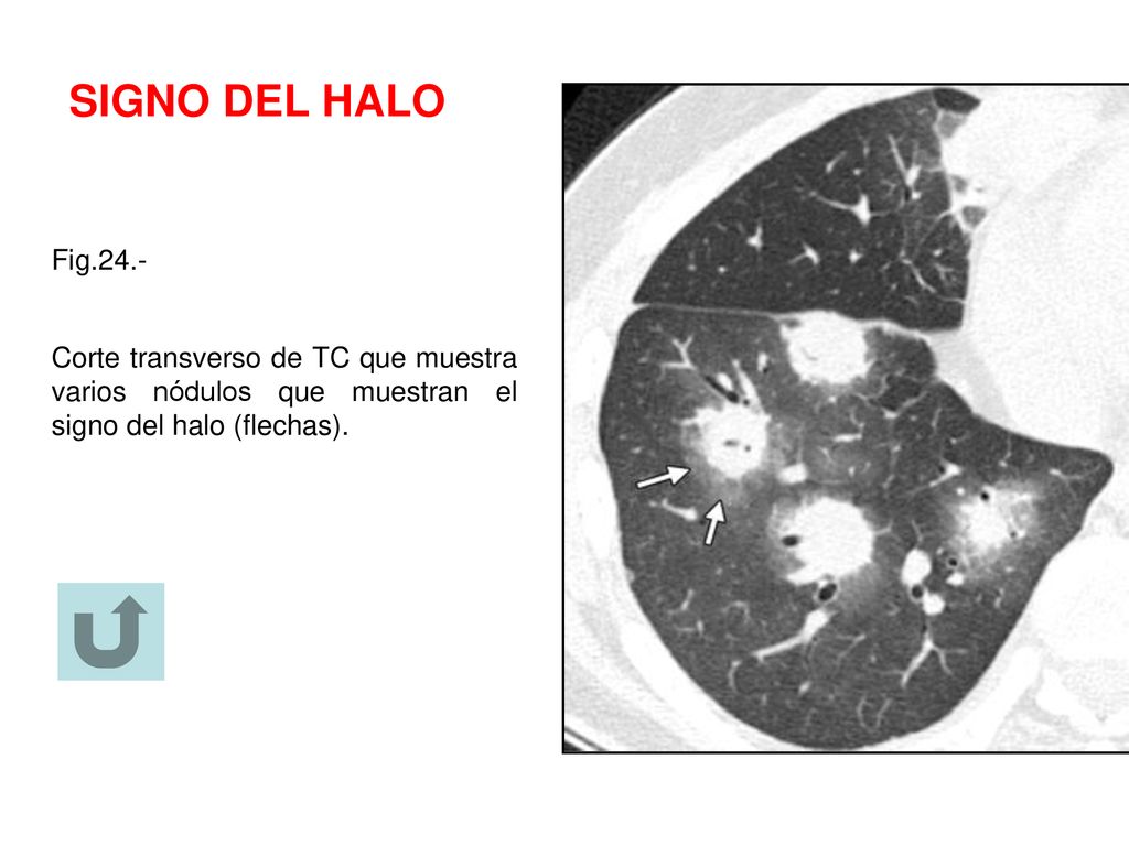 SIGNO DEL HALO Fig.24.- Corte transverso de TC que muestra varios nódulos que muestran el signo del halo (flechas).