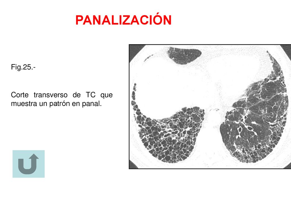 PANALIZACIÓN Fig.25.- Corte transverso de TC que muestra un patrón en panal.