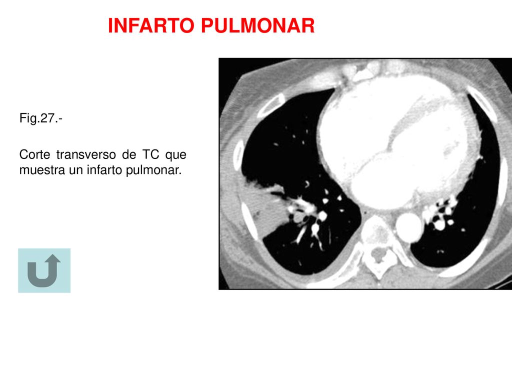 INFARTO PULMONAR Fig.27.- Corte transverso de TC que muestra un infarto pulmonar.