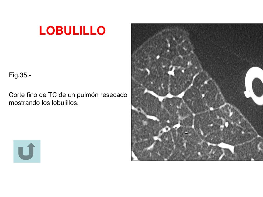 LOBULILLO Fig.35.- Corte fino de TC de un pulmón resecado mostrando los lobulillos.