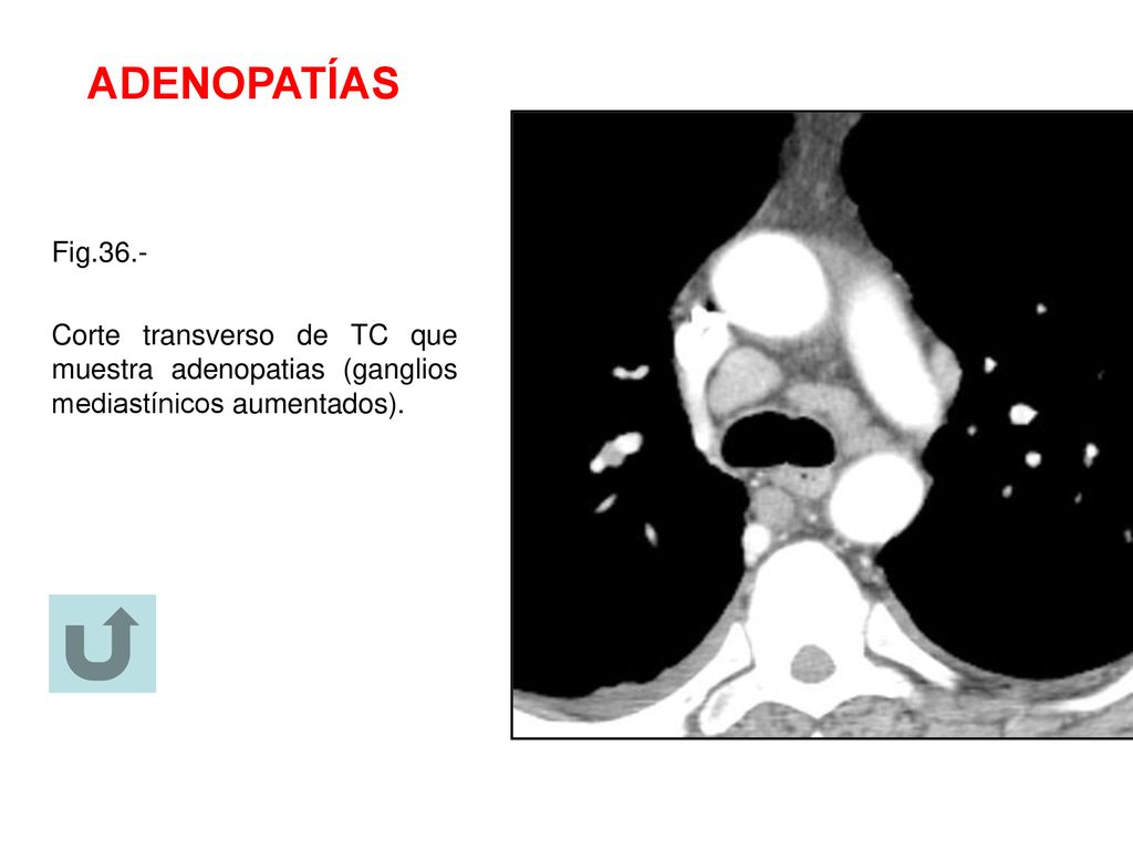 ADENOPATÍAS Fig.36.- Corte transverso de TC que muestra adenopatias (ganglios mediastínicos aumentados).